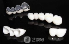 烤瓷牙的副作用是什么？烤瓷牙的寿命是多长？多少钱？