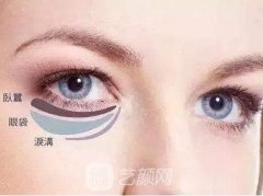 眼袋一旦形成能消除吗？注意事项有哪些？