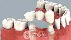 钴铬烤瓷牙的寿命是多少？优缺点是什么？价格是多少？