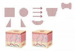 像素激光果怎么样？案例分享，术后两个月果特别棒