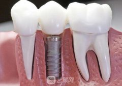 医院种牙多少钱一颗？可以报销吗？能保持多久？