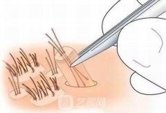 秃顶头发种植需要多少钱？手术过程是怎样的？