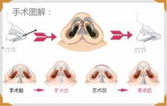 鼻翼整形手术需要多少钱？会留疤吗？手术的方式有哪些？