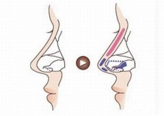 国产假体隆鼻好不好？国产假体隆鼻有哪些材料？