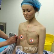 北京八大處整形醫院豐胸價格表|豐胸真實案例