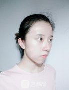 北京东方瑞丽李晓东的pSV技术如何?面部提升除皱案例