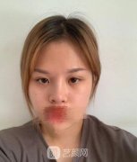 上海双眼皮修复医生案例，苏薇洁医生帮你重获大眼~