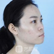 2021成都八大处热玛吉抗衰案例揭晓!