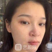 北京联合丽格杨大平面部提升真实抗衰果!
