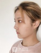 北京润美玉之光脂肪填充面案口碑怎么样?专家案例一览