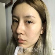 北京伊美尔热玛吉案例分享一览