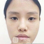 华西口腔医院整形科下颌角手术多少钱？真人案例一览