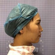 上海九院戴传昌鼻案例，亲身经历恢复全过程果图