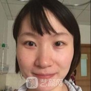 上海首尔丽格整形医院颧骨磨骨果怎么样？案例分享