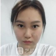 上海华美整形医院专家医师面部吸脂案例一览