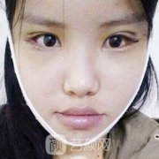 上海做下颌角多少钱？参考下颌骨截骨案例及医生手术价格表