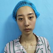 上海华山医院整形科五代热玛吉抗衰案例分享
