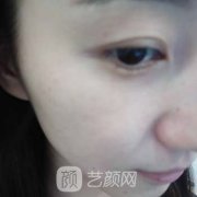 上海九院热提拉挂什么科？果好嘛？附热提拉案例