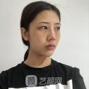 上海慕正医疗美容案例，眼袋失败修复果图