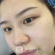 乌鲁木齐军区总医院整形科割双眼皮怎么样？案例上线！