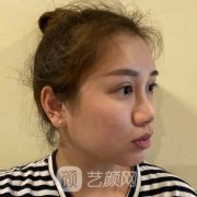 西安医学院第二附属医院整形科隆鼻案例多图参考！
