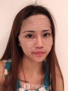 四川华美紫馨脂肪填充面部口碑案例对比图一览