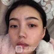 苏州美莱尹飞割双眼皮好吗？有术后案例和价格可了解！