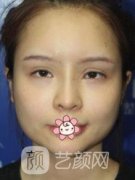 吴中兴正颌手术技术怎么样？医生案例果图及真实价格分享