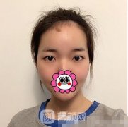 上海九院双眼皮案例在哪看？亲身经历双眼皮恢复全过程