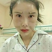 北京东方和谐自体脂肪填充面部案例图片分享