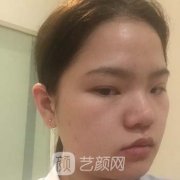 北京八大处范飞做鼻子案例，术后两个月很满意~