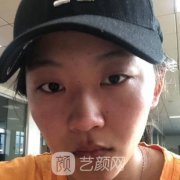 上海九医院整形张艳技术怎么样？双眼皮案例图