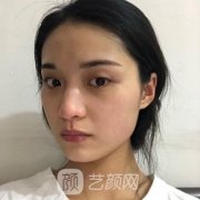 佳木斯美白整形医院做双眼皮真实案例果参考