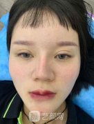 淮安市第二人民医院整形美容科洗眉咋样？案例果价格一览