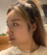 上海九院韦敏事件，下颌角磨骨真实案例恢复全过程~