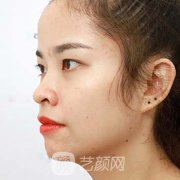 安医附二院整形科双眼皮怎么样？案例多图鉴赏！