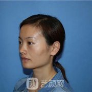 北京京美整形自体脂肪丰额头价格表|专家案例图分享