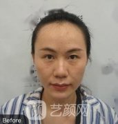 北京八大处整形外科医院植发价格怎么样？哪个医生做得好？案例参考