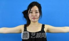 北京余若晖吸脂怎么样？手术案例果图