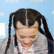 北京薇琳植发怎么样？发际线种植果如何？真人案例及价格揭晓！