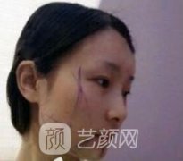 北京圣嘉新整形医院磨骨多少钱?附价格表+张笑天案例术后图
