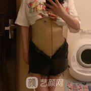 上海光博士李彬医生抽脂怎么样？案例果及价格表全新展现！