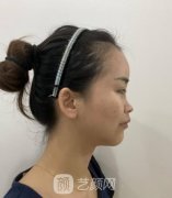 上海鲁南整形医院做鼻子案例前后照片！公布手术价格收费标准