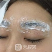 上海九院提眉手术多少钱？林晓曦医生案例