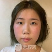 温州附属第一医院整形科双眼皮案例及在线预约！