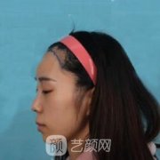 长春海峡整形医院植发怎么样？看案例详解！