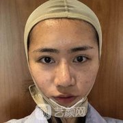 湘雅附二整形王先成面部吸脂案例公布！并附美容项目价格收费明细