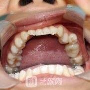 无锡通善口腔医院种植牙收费怎么样？医生案例果参考