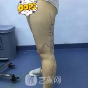 大连中心医院整形科价目表收费明细|吸脂案例图分享
