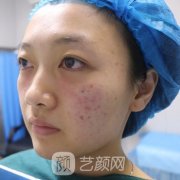 济南爱容整形医院价格表2021|去眼袋案例果展示